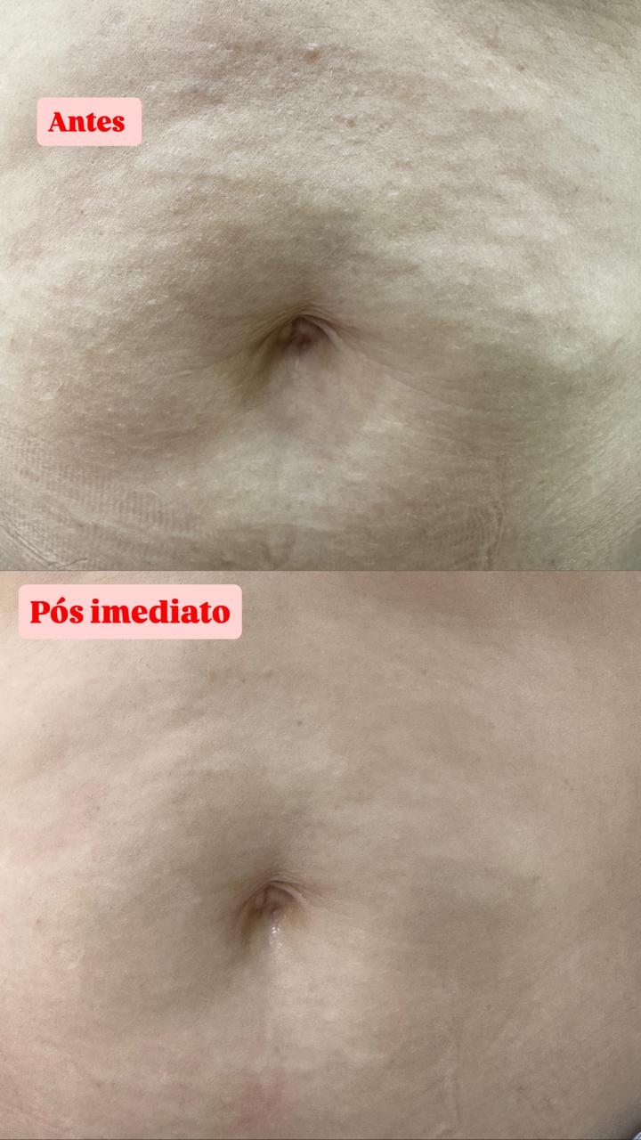 Antes e depois região corporal