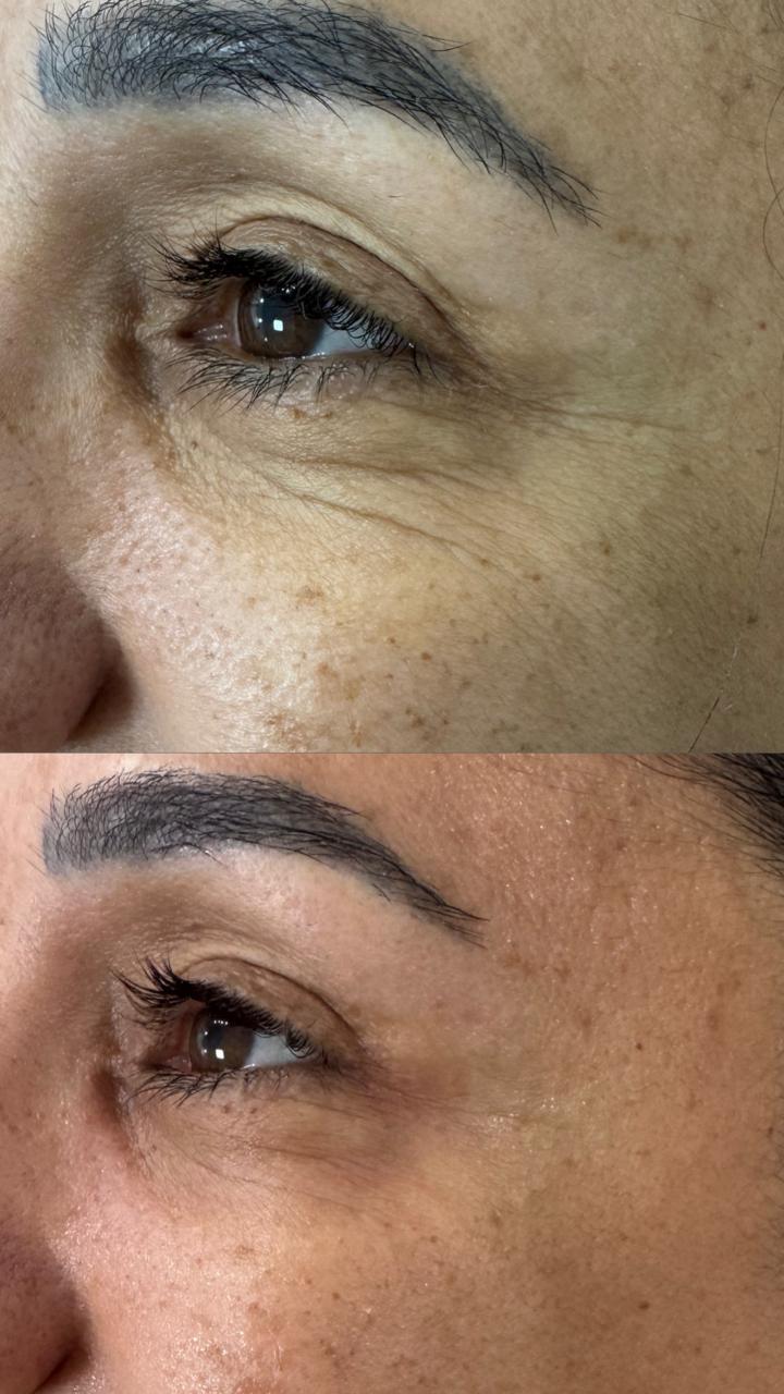 Antes e depois região dos olhos